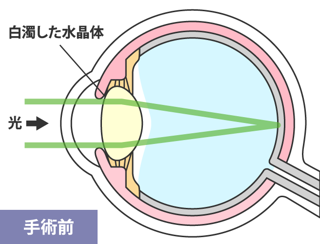 手術前