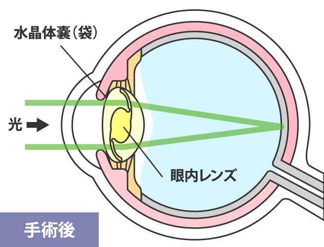 手術後