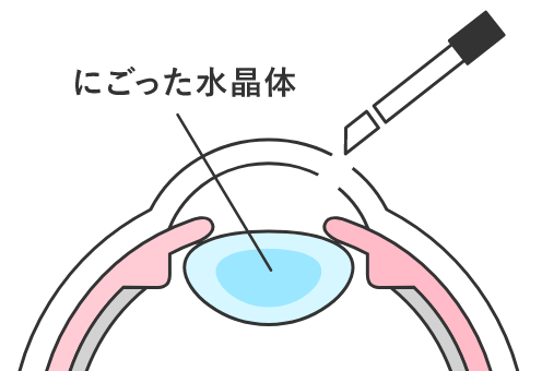 にごった水晶体