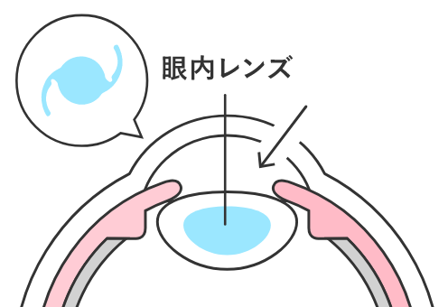 眼内レンズ