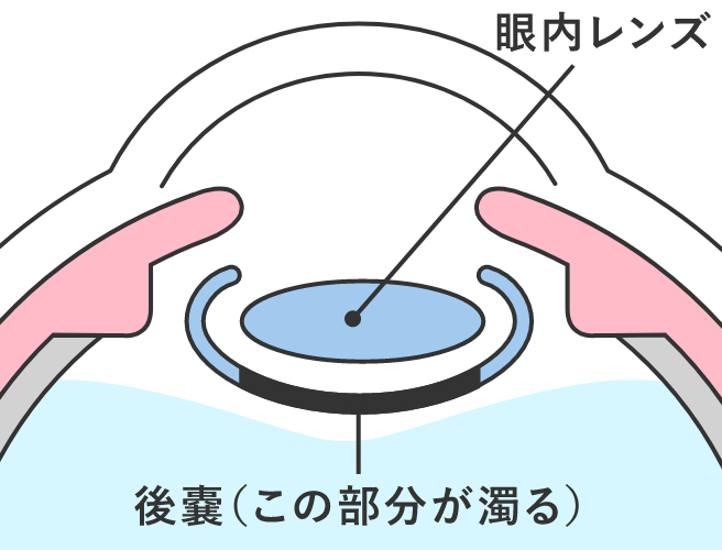 後発白内障の治療1