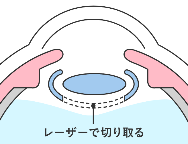 後発白内障の治療2