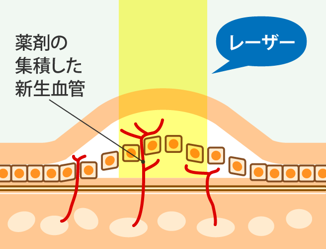 PDT療法1