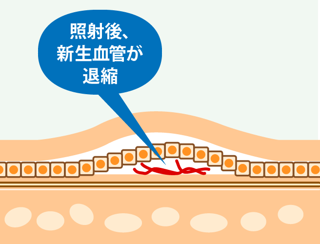 PDT療法2