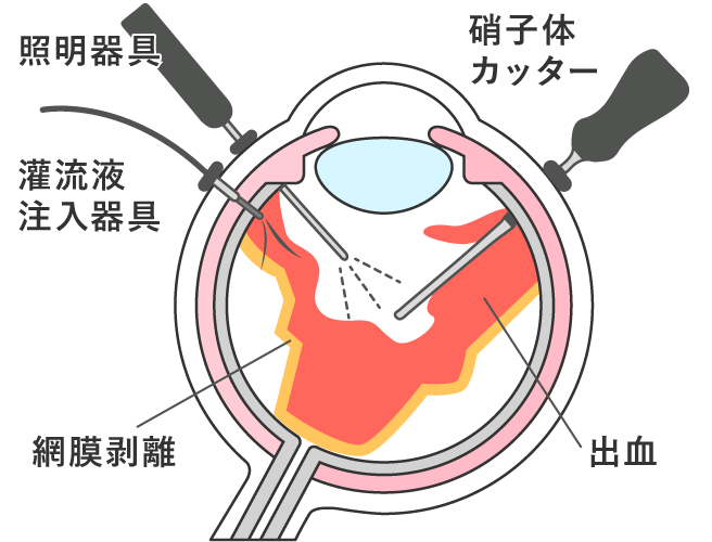 硝子体手術