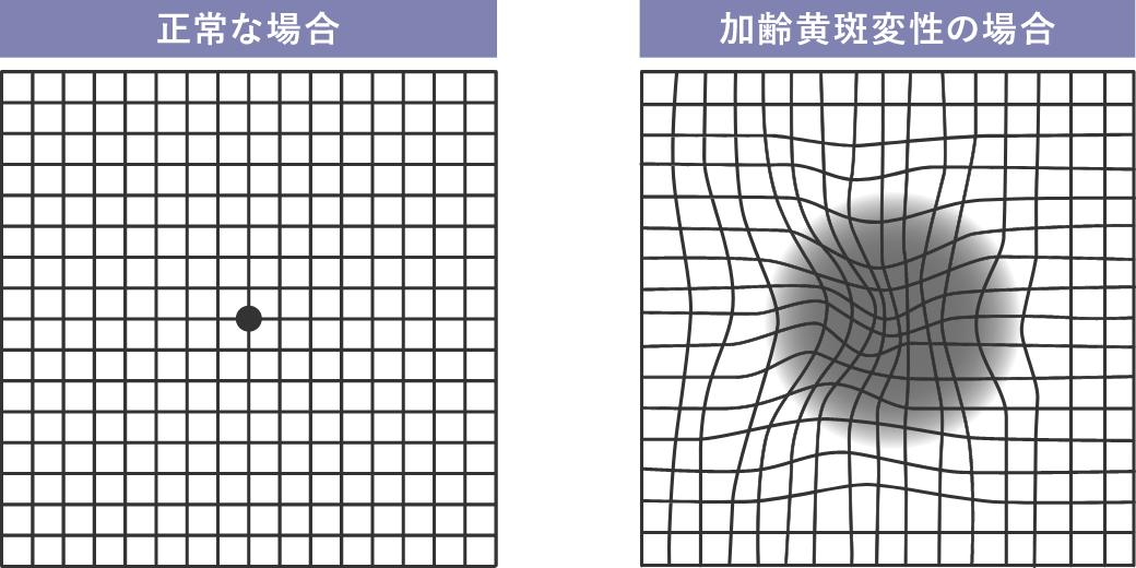 アムスラー検査