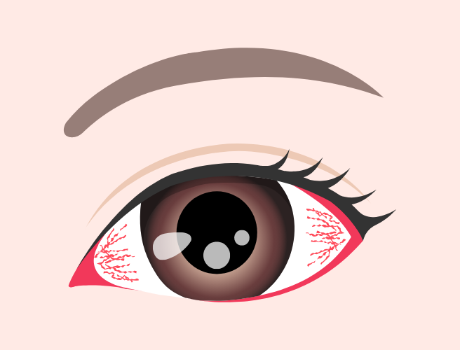 ドライアイについて