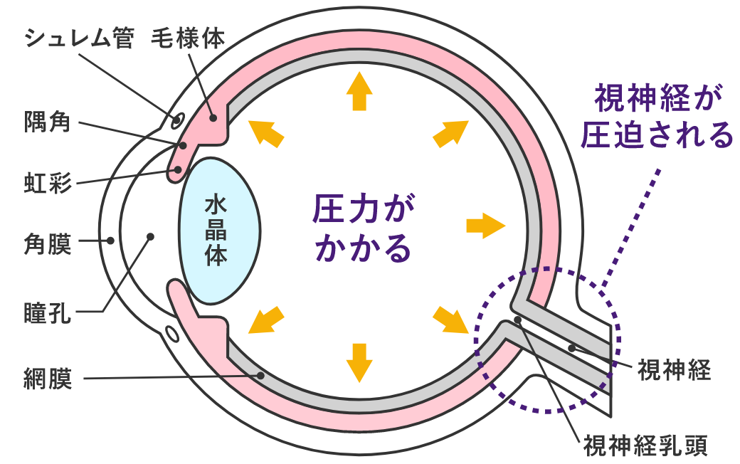 緑内障の治療