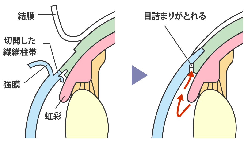 低侵襲緑内障手術について