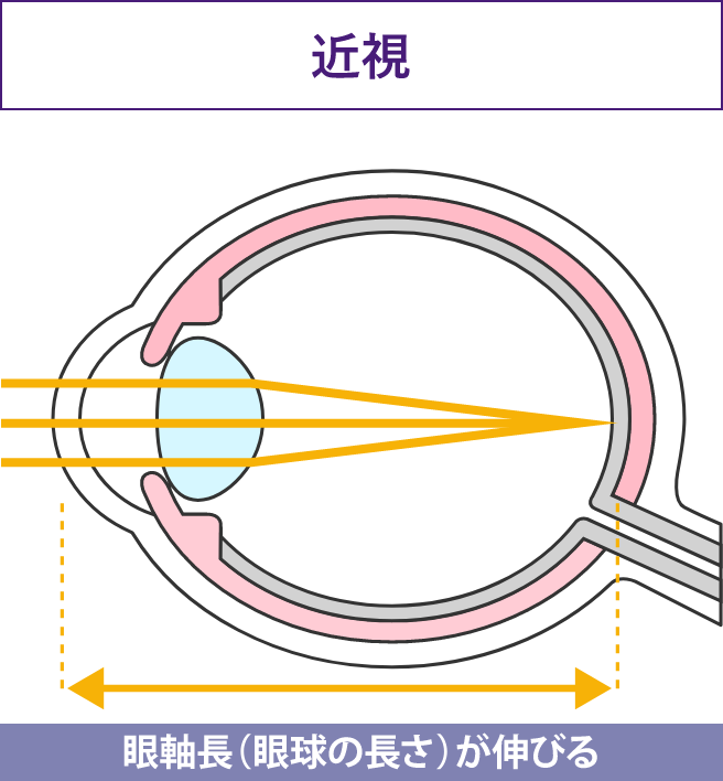 近視