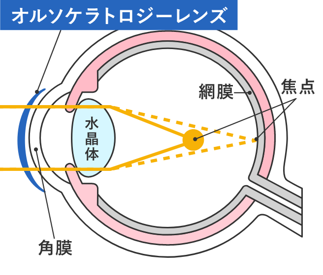 オルソケラトロジーとは
