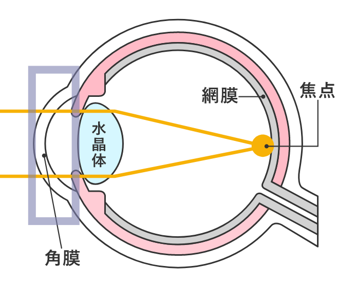 オルソケラトロジーとは